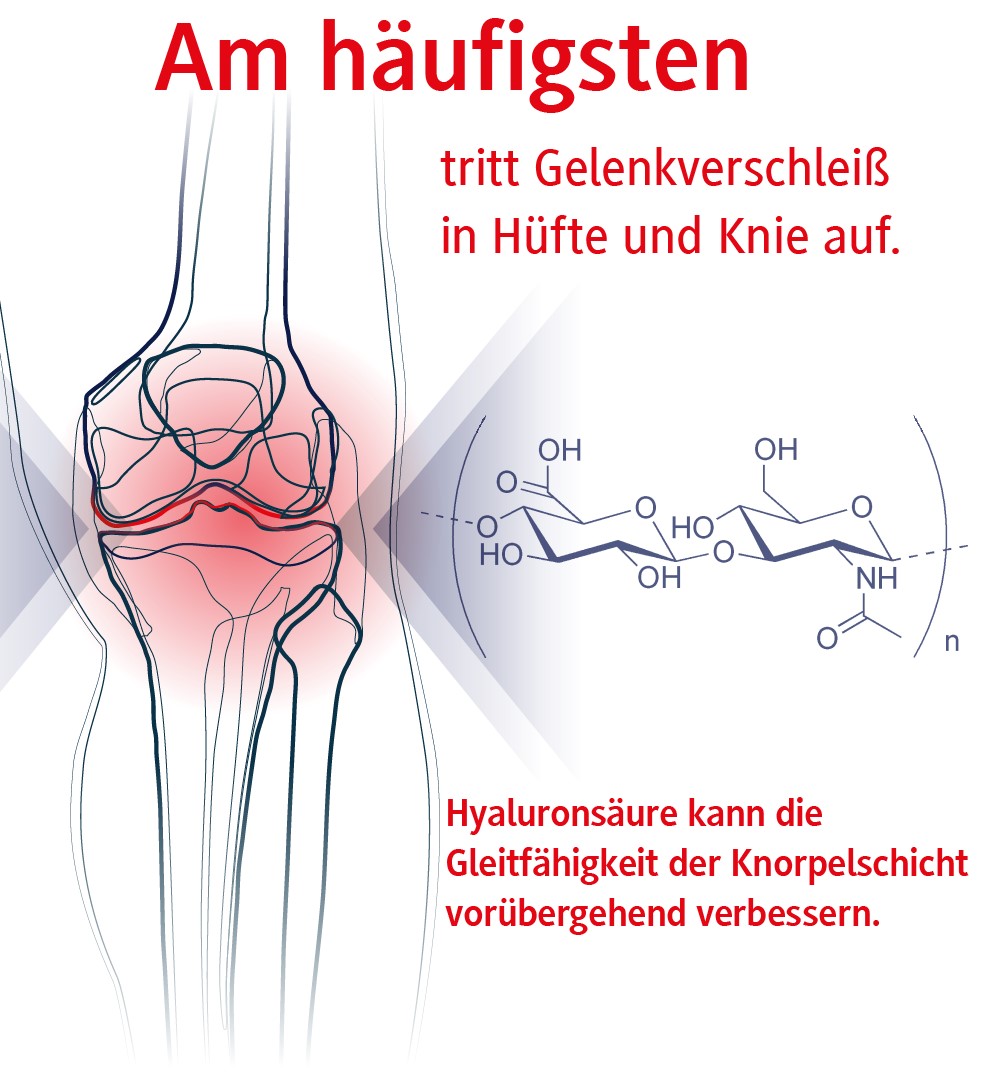 Gelenkprobleme lassen sich konservativ Behandeln